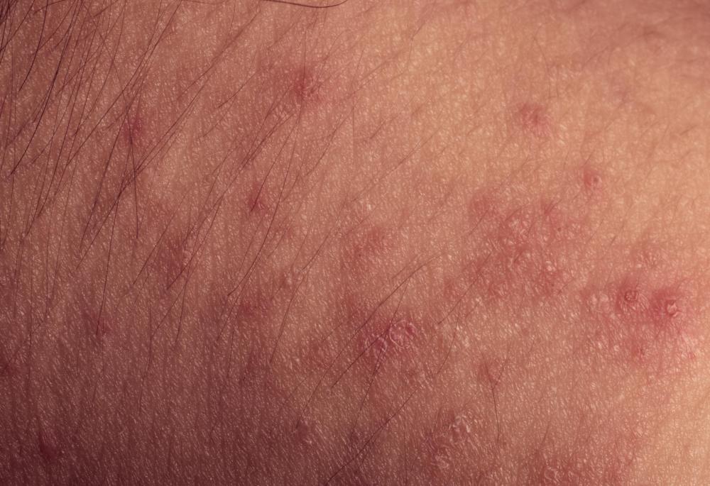 What Are The Signs Of An Allergic Reaction To Adhesive