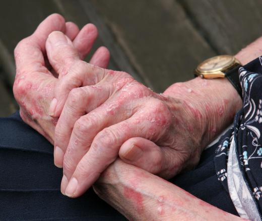 Kaolin has been used for years to dry poison ivy rashes.