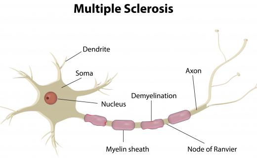 Some believe that cognitive tests can predict whether a person will suffer from multiple sclerosis later in life.