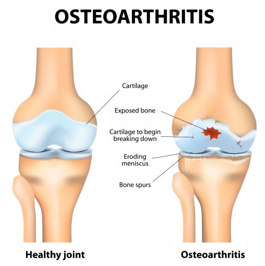 No cure currently exists for osteoarthritis, which can lead to the severe degradation of cartilage on one or more joints of the body.