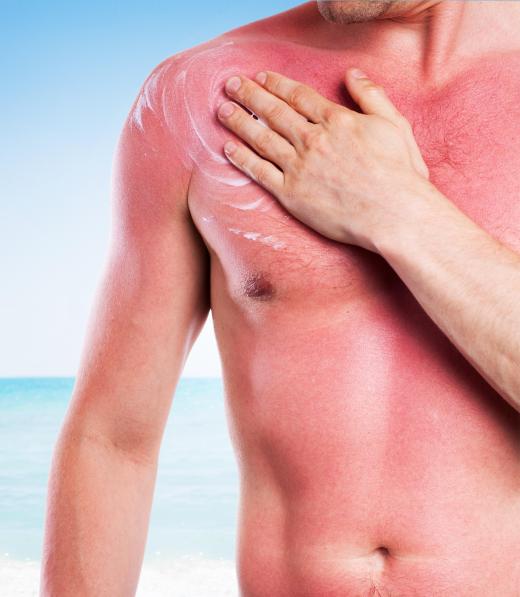 Lifeguard chairs with sunshades can help lifeguards avoid getting severe sunburns.