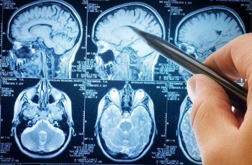 Brain cancer can arise out of glial cell disorders.